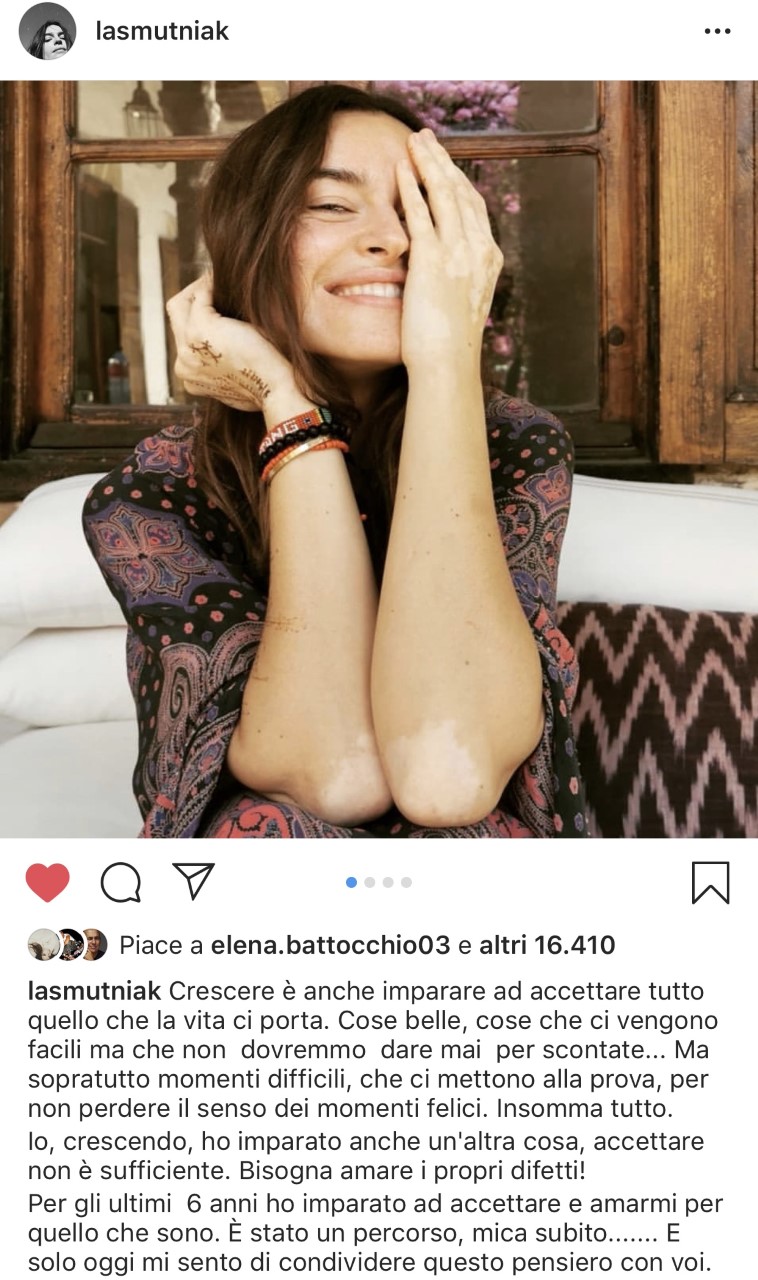 Kasia Smutniak E Il Post Su Instagram Che Racconta La Vitiligine Ho